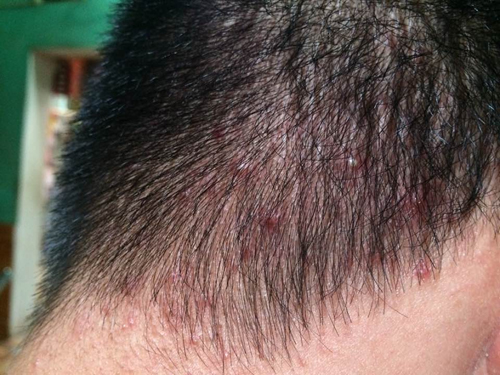 Một trong những biểu hiện của bệnh ung thư da đầu là đầu xuất hiện rải rác các mụn đỏ