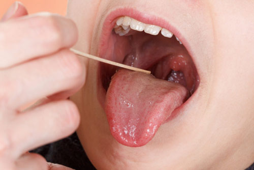 Biểu hiện ung thư lưỡi giai đoạn cuối