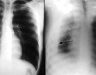 Hình ảnh ung thư màng phổi – Phương pháp điều trị K màng phổi