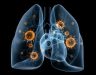 Các giai đoạn của ung thư phổi. Dấu hiệu cảnh báo mắc bệnh K phổi
