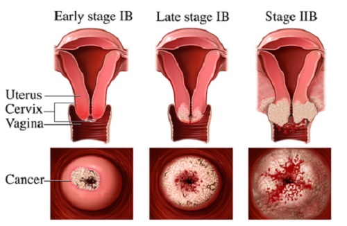 Các giai đoạn ung thư cổ tử cung