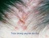 Triệu chứng ung thư da đầu và biện pháp ngăn ngừa bệnh hiệu quả