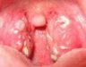 Cách nhận biết sớm ung thư vòm họng và cách điều trị hiệu quả