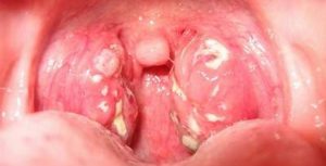 Cách nhận biết sớm ung thư vòm họng