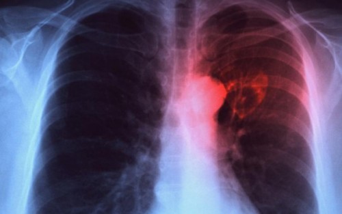 Chụp X - quang là một phương pháp chẩn đoán hình ảnh ung thư phổi