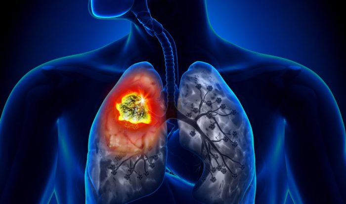 Có những loại ung thư nào khó phát hiện, đó là ung thư phổi.