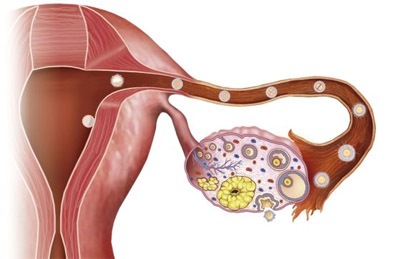 Nguyên nhân ung thư buồng trứng từ một khối u hình thành ở buồng trứng