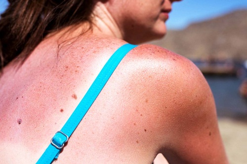 Thường xuyên tiếp xúc ánh nắng mặt trời giờ cao có nguy cơ ung thư da