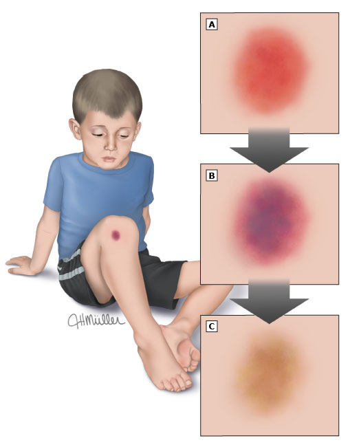 Dấu hiệu ung thư ở trẻ em, thường hay xảy ra do trẻ nghịch ngợm