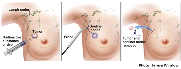 Dấu hiệu người bị ung thư tuyến vú thường xuất hiện u ở trong vú