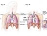 Giai đoạn đầu của ung thư phổi: Nguyên nhân và triệu chứng bệnh