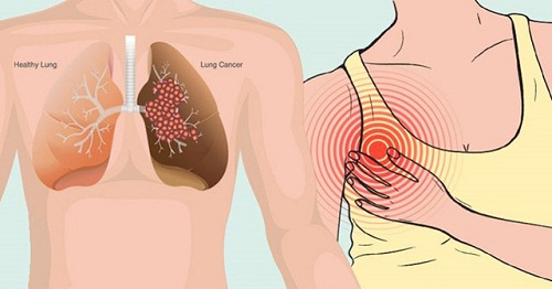 Những triệu chứng của giai đoạn đầu ung thư phổi bạn cần lưu ý