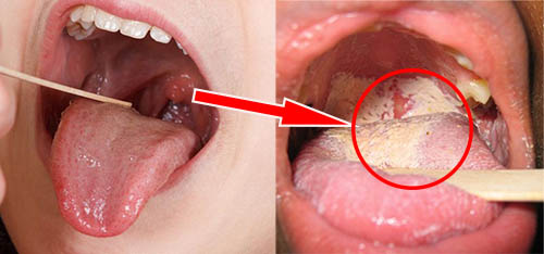 Giai đoạn phát triển ung thư lưỡi như thế nào?