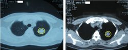Qua hình ảnh CT ung thư phổi các bác sĩ có thể phát hiện ra các khối u