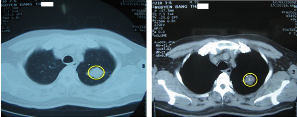 Hình ảnh CT ung thư phổi như thế nào? Chụp CT có phát hiện bệnh?