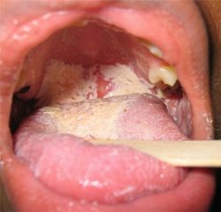 Dấu hiệu điển hình của bệnh ung thư lưỡi là xuất hiện các mảng trắng