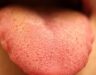 Hình ảnh bị ung thư lưỡi: Dấu hiệu nhận biết ung thư lưỡi