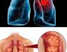 Hình ảnh cho bệnh ung thư phổi - Dấu hiệu nhận biết và cách điều trị