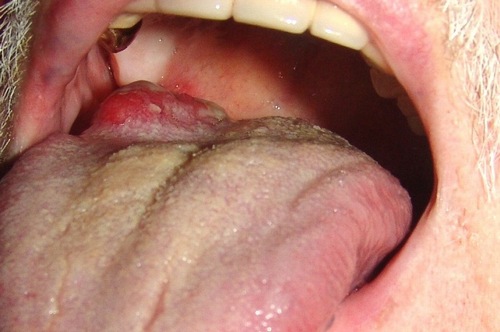 Hình ảnh cho ung thư lưỡi nguy hiểm