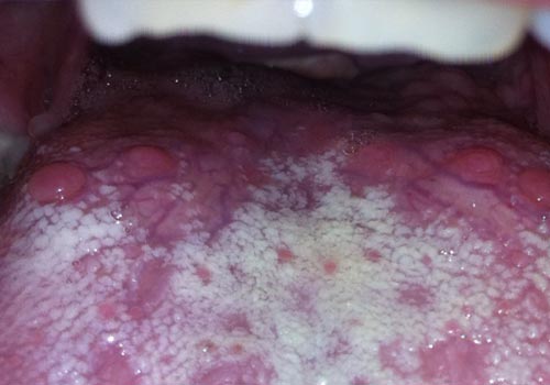 Hình ảnh của ung thư lưỡi nguy hiểm