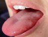 Hình ảnh lưỡi bị ung thư có đặc điểm gì giúp phát hiện bệnh