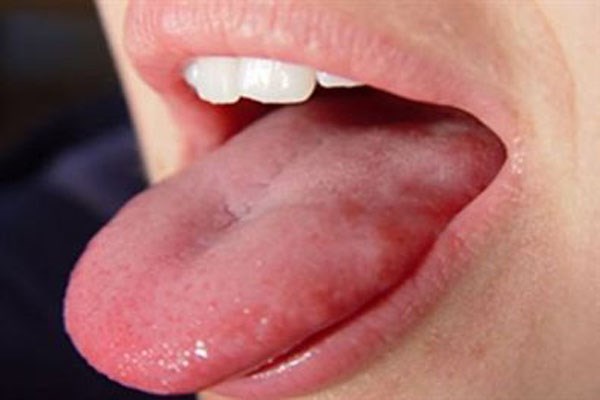 Hiểu rõ về hình ảnh lưỡi bị ung thư giúp bạn sớm phát hiện bệnh