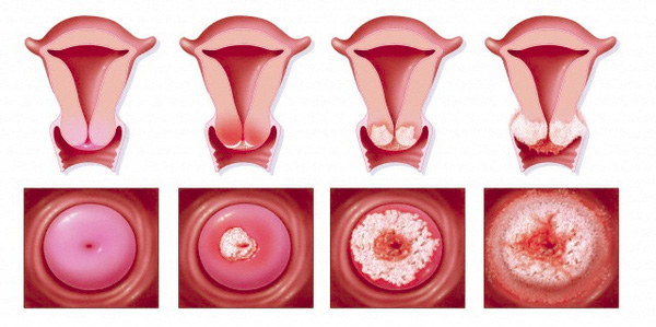 Hình ảnh tế bào ác tính ran rộng trong cổ tử cung