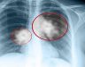 Hình ảnh ung thư phổi trên XQ, dấu hiệu giai đoạn ung thư phổi