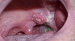 Xuất hiện mủ và các khối u nhiều hơn trong khoang miệng