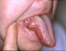 Hình ảnh của bệnh ung thư lưỡi: Dấu hiệu nhận biết ung thư lưỡi