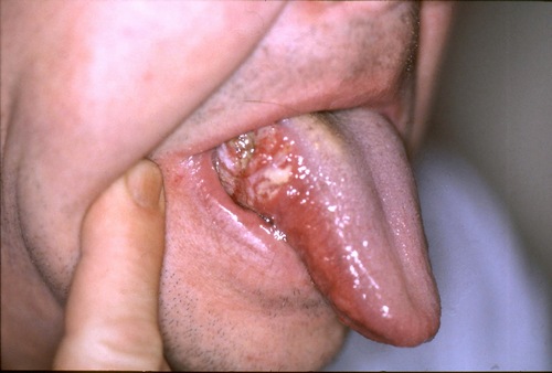 Hình ảnh của bệnh ung thư lưỡi giai đoạn đầu