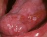 Nguyên nhân gây bệnh ung thư lưỡi. Cách điều trị và phòng ngừa