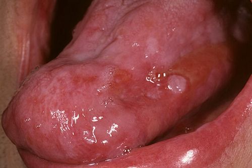 Hình ảnh ung thư lưỡi dễ nhầm lẫn với nhiệt miệng