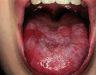 Hình ảnh bệnh ung thư lưỡi – Cách phòng tránh bệnh ung thư lưỡi