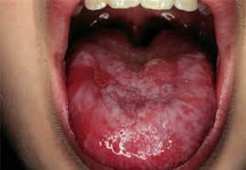 Hình ảnh bệnh ung thư lưỡi