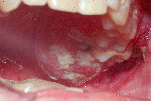 Hình ảnh ung thư miệng