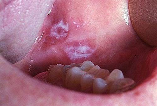 Hình ảnh ung thư sàn miệng
