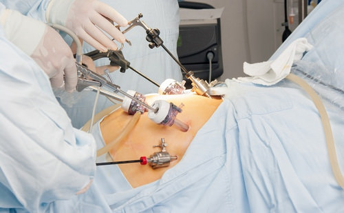 Phẫu thuật túi mật là một phương pháp chủ yếu để điều trị bệnh ung thư túi mật