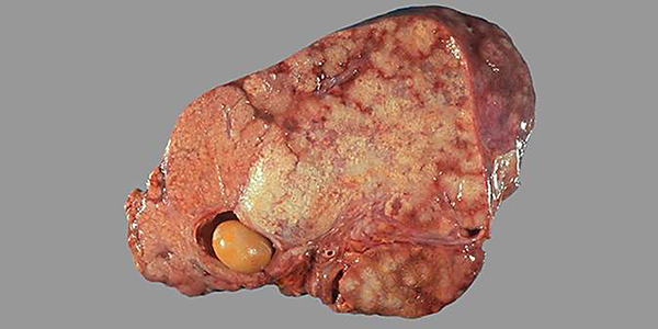 Hình ảnh ung thư túi mật khi bệnh bước sang giai đoạn nguy hiểm