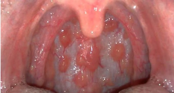 Ung thư giai đoạn cuối xuất hiện các khối u và hạch ở cổ họng