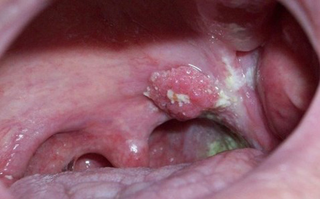 Bệnh nhân xuất hiện các khối u có mủ trong cổ họng