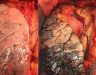Chẩn đoán hình ảnh ung thư phổi với các phương pháp hiện đại nhất