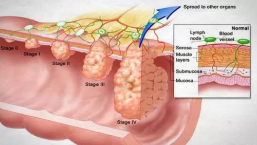 Các giai đoạn phát triển của ung thư đại tràng