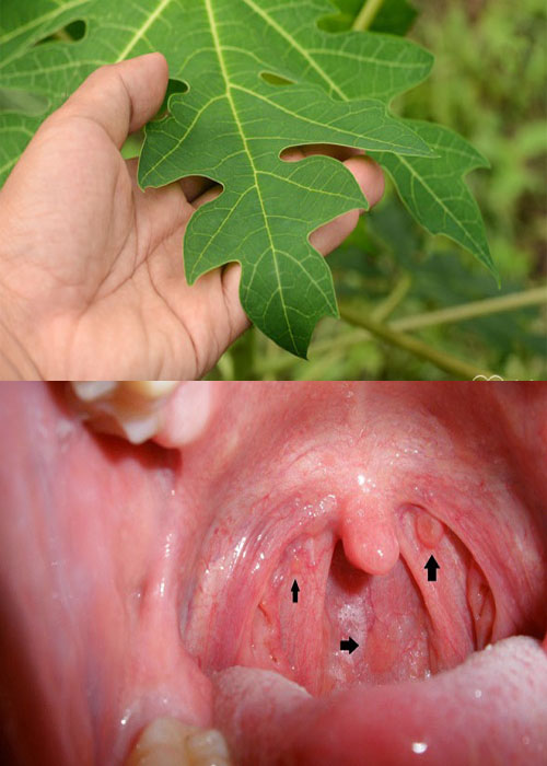 Bài thuốc dùng lá đu đủ chữa ung thư vòm họng có nguồn gốc từ Australia.