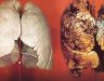 Ung thư phổi có di truyền hay không? Yếu tố gây ung thư phổi