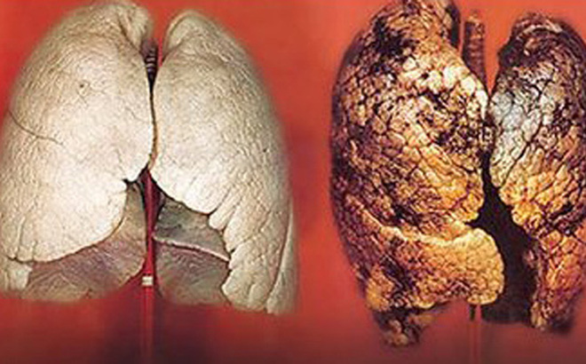 Nên làm gì khi phát hiện ung thư phổi?