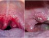 Ngăn ngừa ung thư vòm họng: Kiến thức phòng tránh bệnh hiệu quả