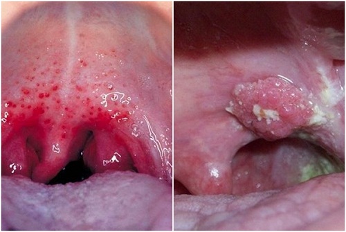Biện pháp ngăn ngừa ung thư vòm họng hiệu quả là gì?