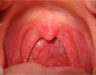 Nguyên nhân bệnh ung thư vòm họng là gì? Ung thư vòm họng do đâu?