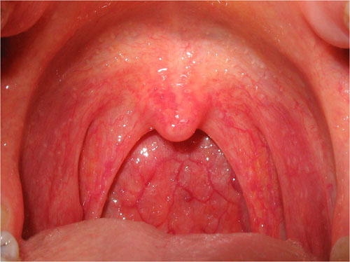 Nguyên nhân bệnh ung thư vòm họng do thói quen sinh hoạt nhiều.